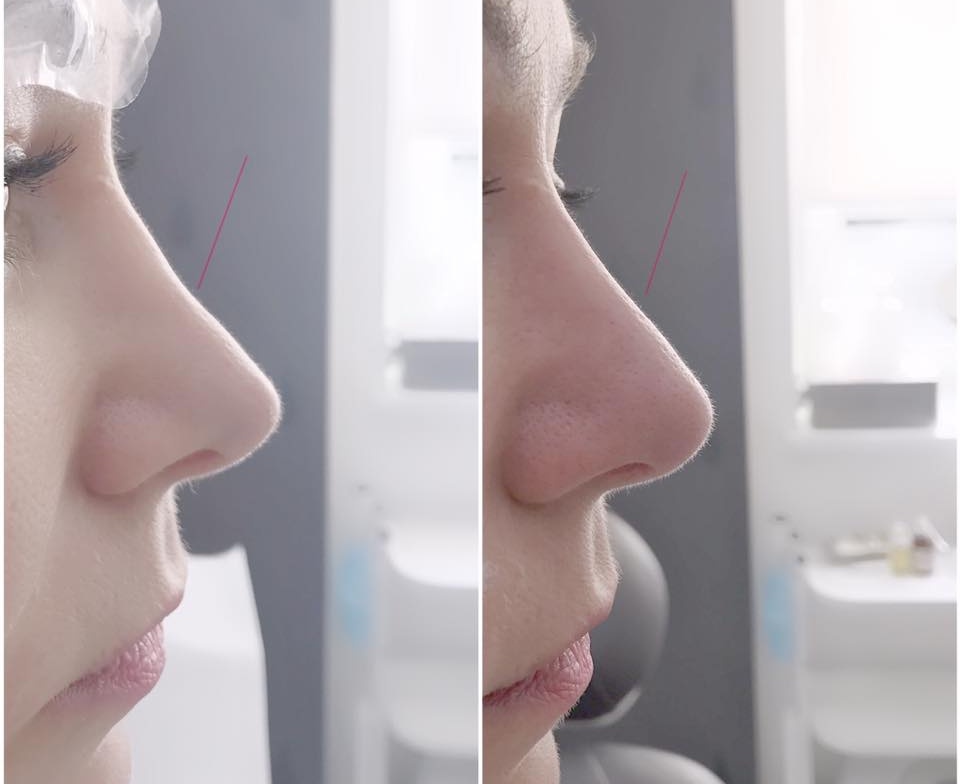 medycyna estetyczna nos